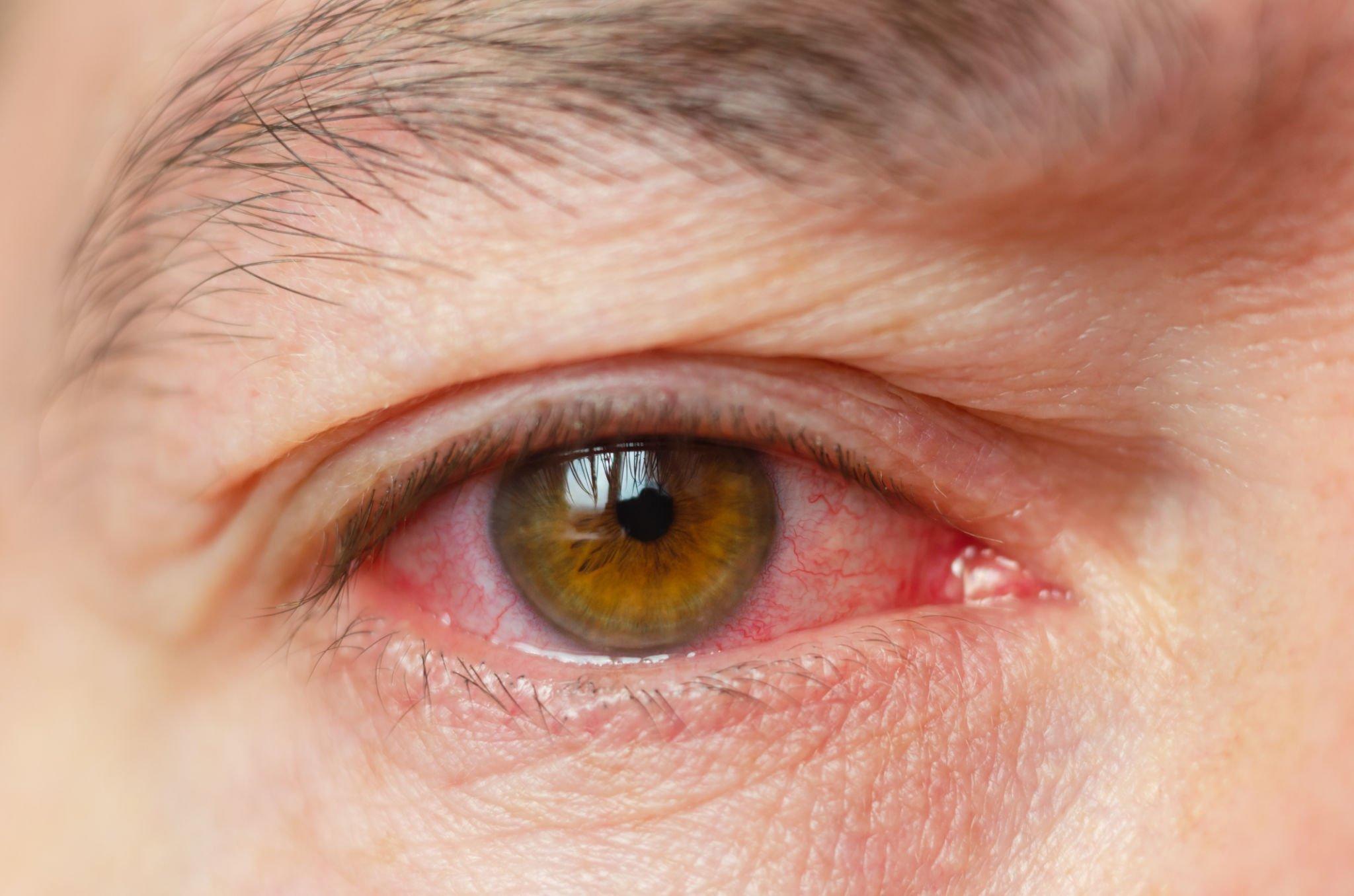 Conjunctivitis