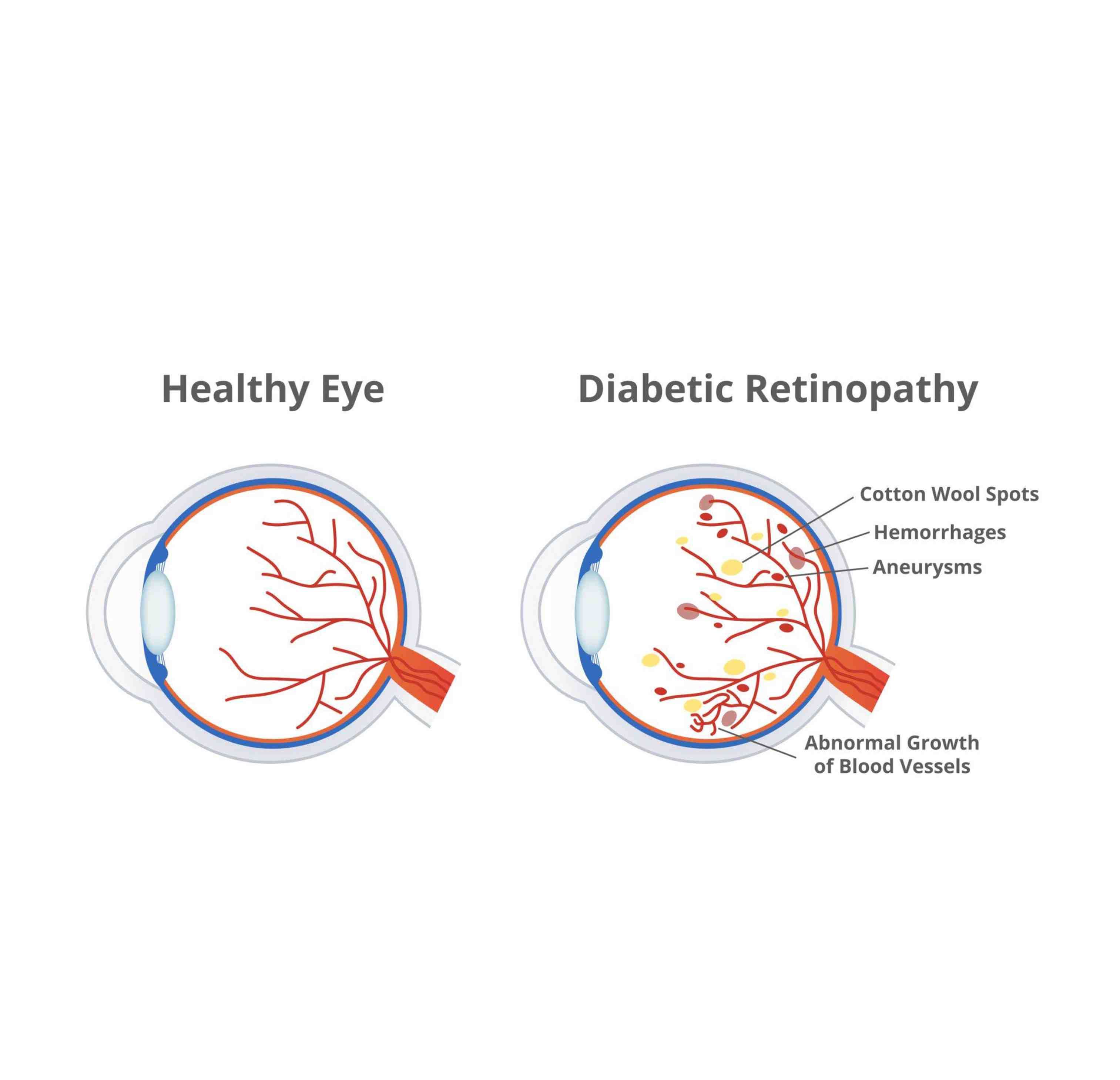 Diabetic Retinopathy