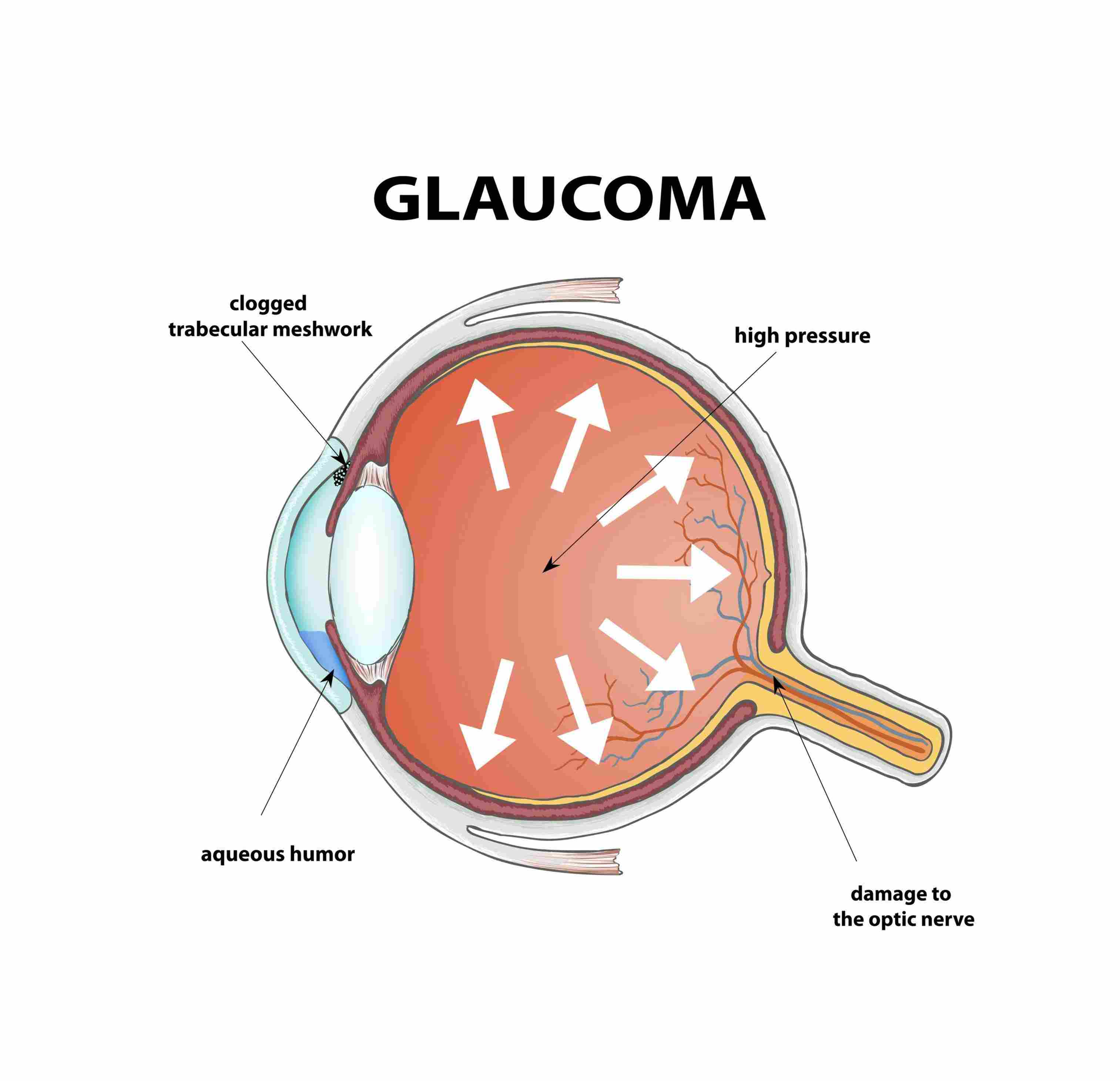 Glaucoma