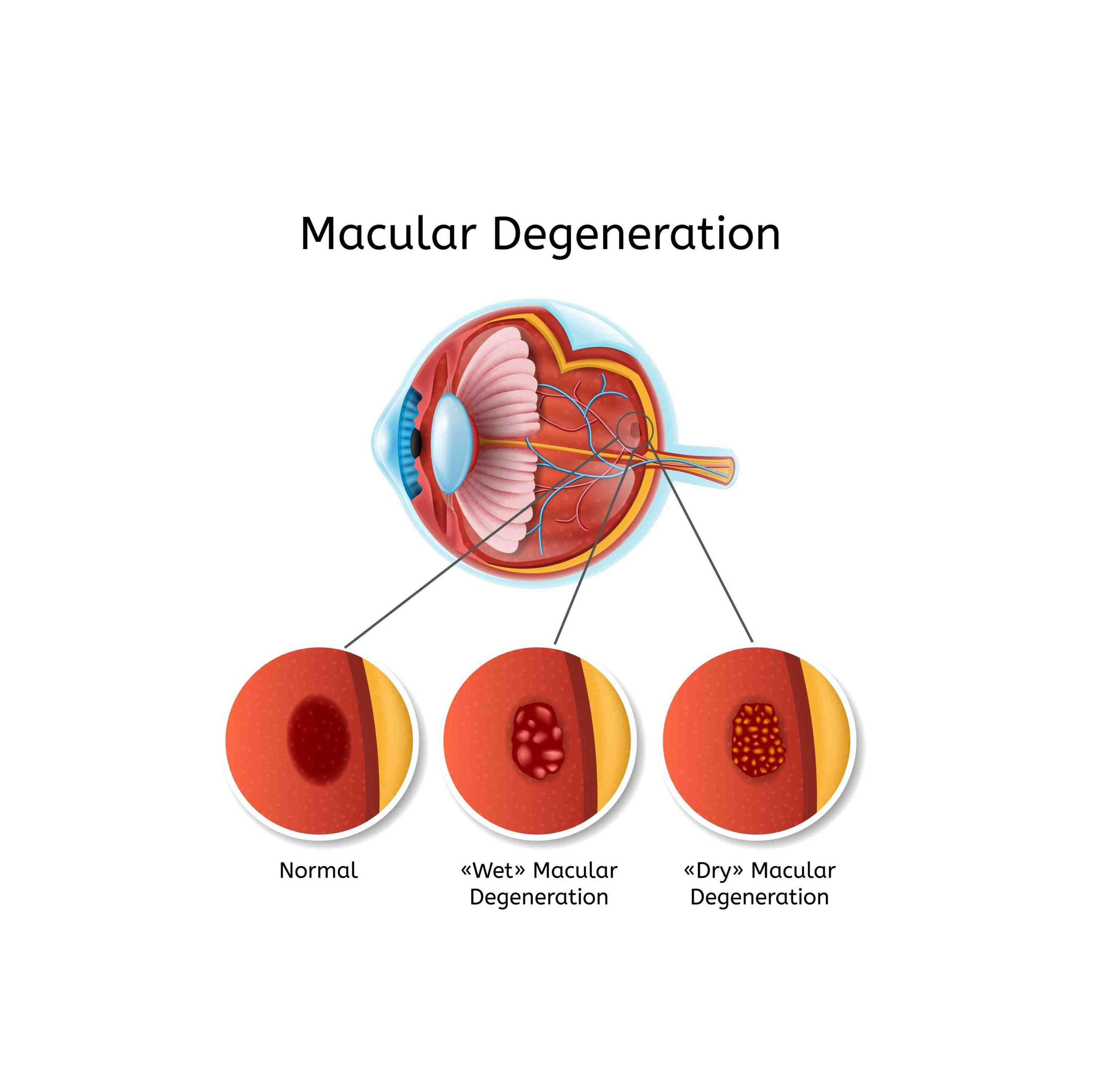 Macular Degeneration