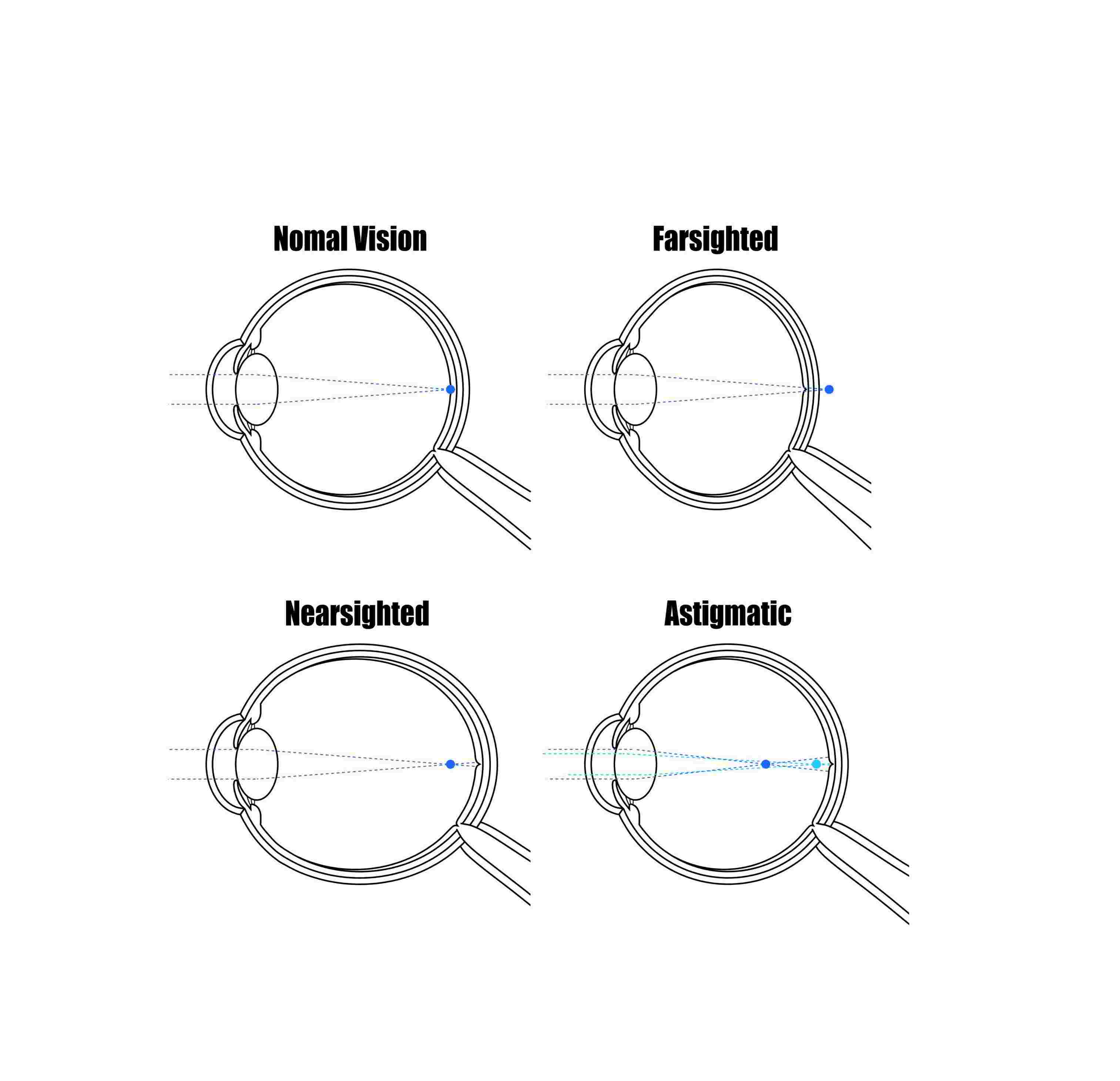 Refractive Errors